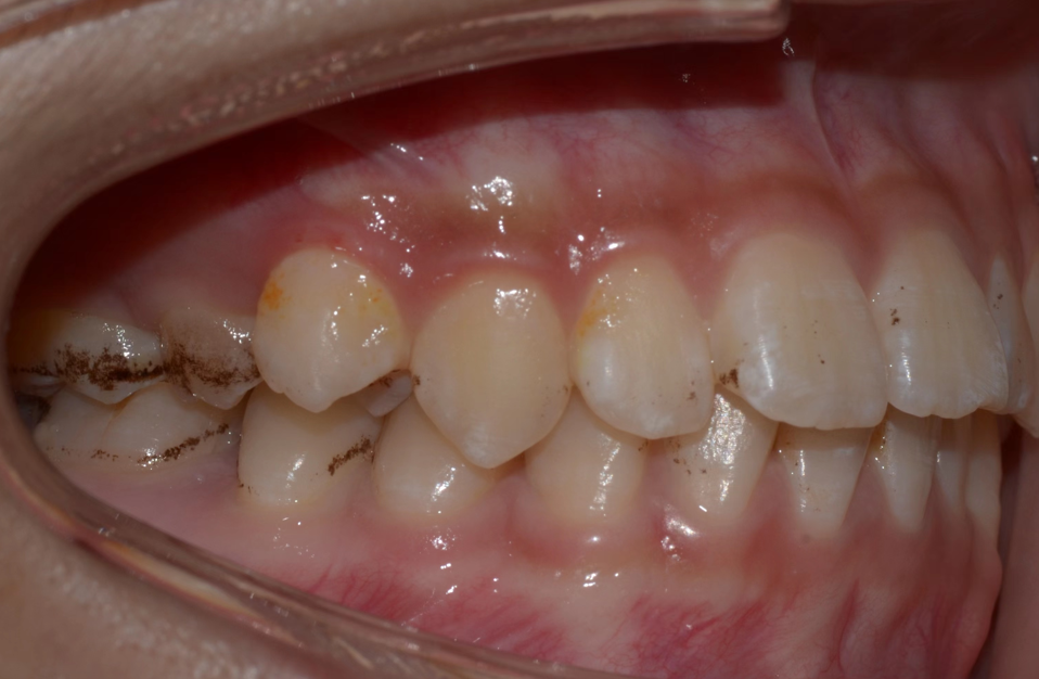 “矫颜”隐形正畸解决后牙锁颌 “矫颜”隐形正畸解决后牙锁颌